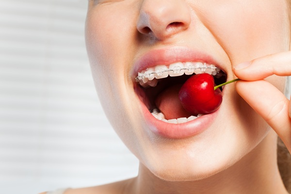 Clear Braces Vs Aligners